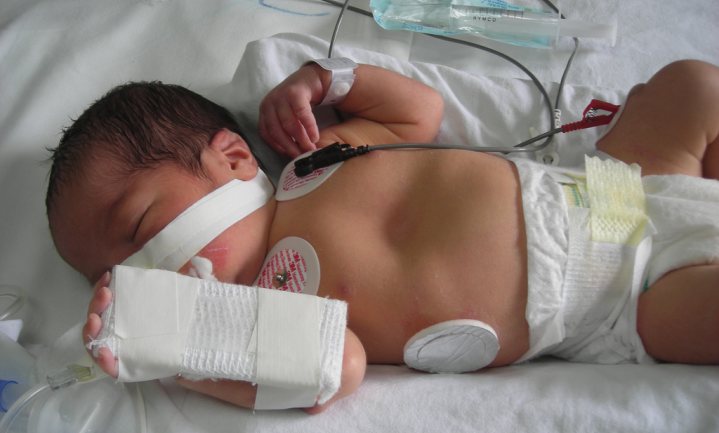 Europa had 50.000 open rug baby’s kunnen voorkomen door minder voorzichtig beleid