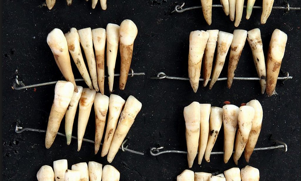 ‘Waterloo teeth’ - kunstgebitten met echte tanden